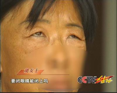 美容手术引来祸端 去皱破坏神经面部表情消失